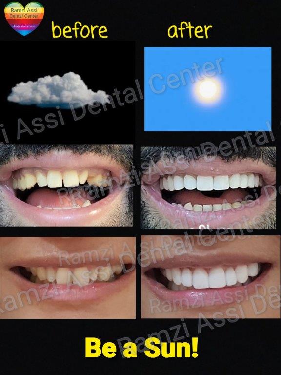 dental veneers